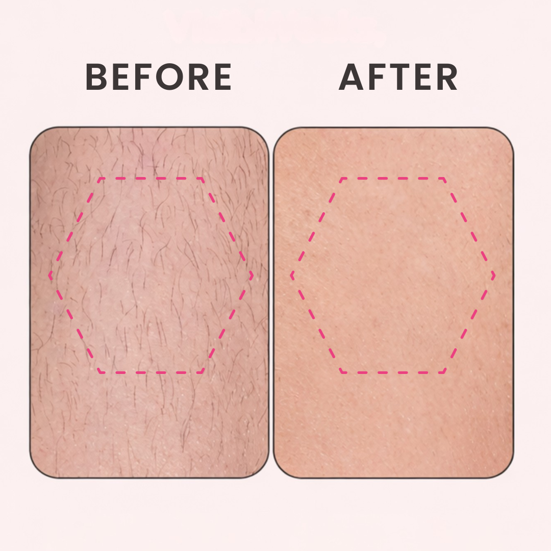 Silvare™ Skin Smooth Pro